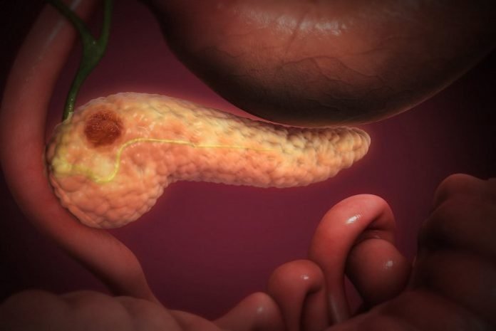 pancreatic-cancer-cannabidiol Pancreatic cancer and cannabidiol